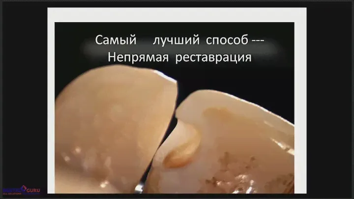 2018 04 10  ГРИГОРЬЕВ А    Методы компенсации полимеризационной усадки, техника прямой реставрации