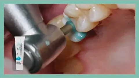 Multilink Automix - Cementing a crown