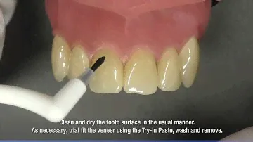 Panavia V5 how to work flow laminate veneer cementation
